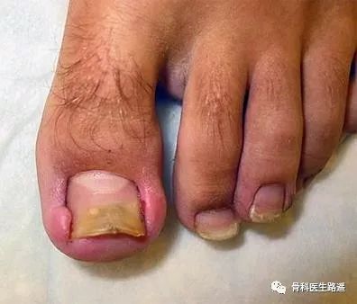 脚趾甲总往肉里长得了嵌甲怎么办