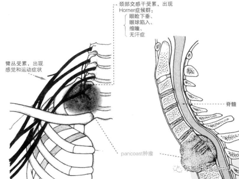 颈肋综合征图片