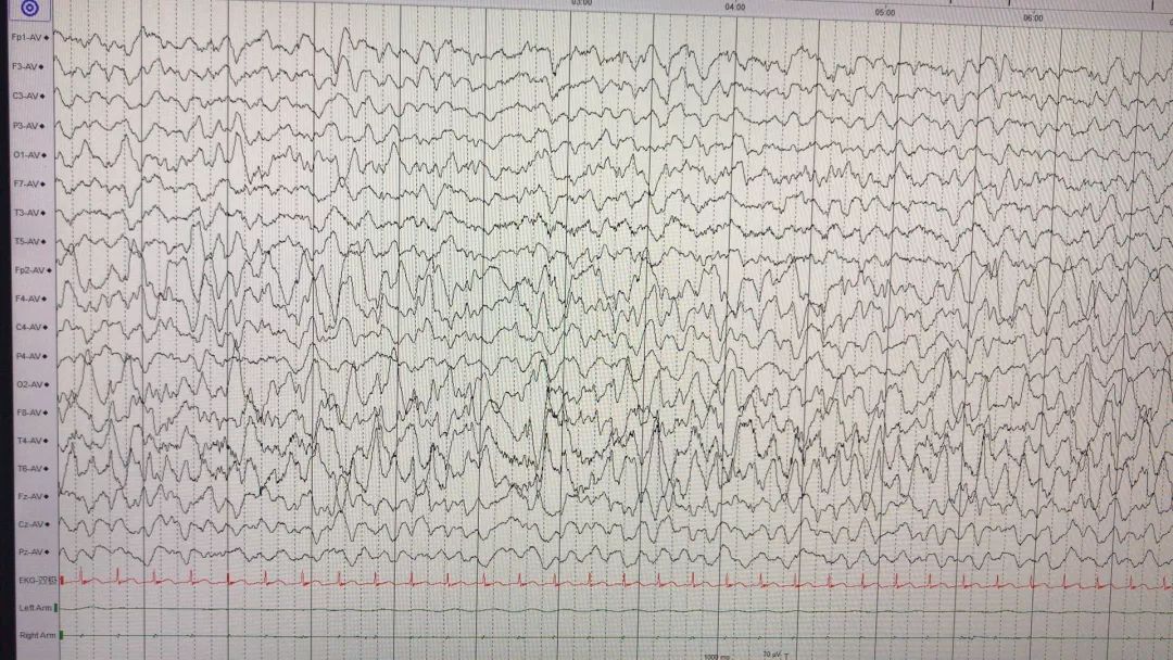 儿童脑电图异常图片