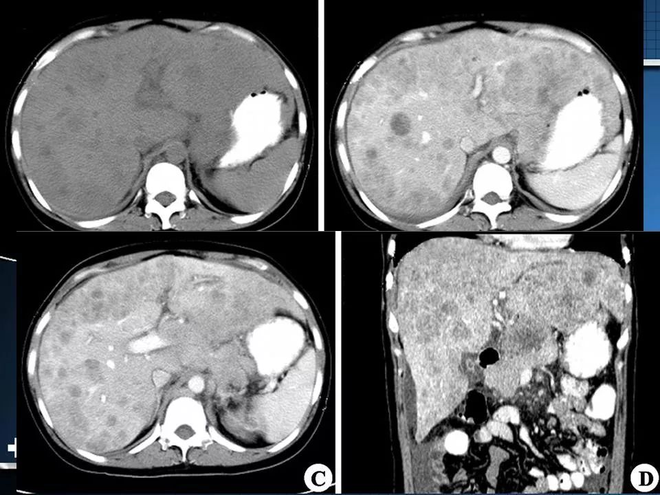 原发性肝癌的影像诊断影像天地