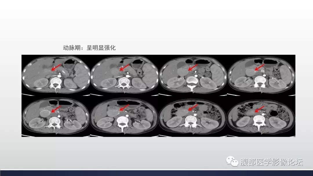 腹膜後巨淋巴結增生症