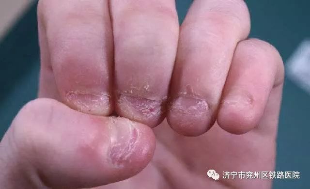【科学育儿】孩子咬指甲并非是缺少维生素!