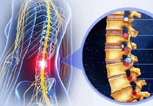 腰椎间盘突出到底能否彻底治愈