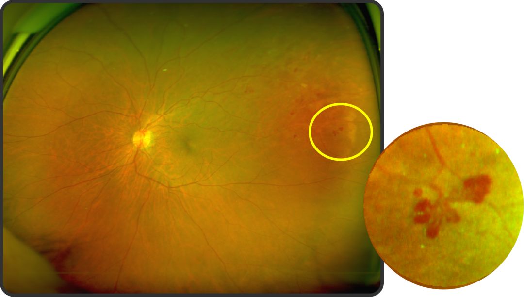 超广角眼底照相欧堡入驻贵港爱尔眼科医院啦