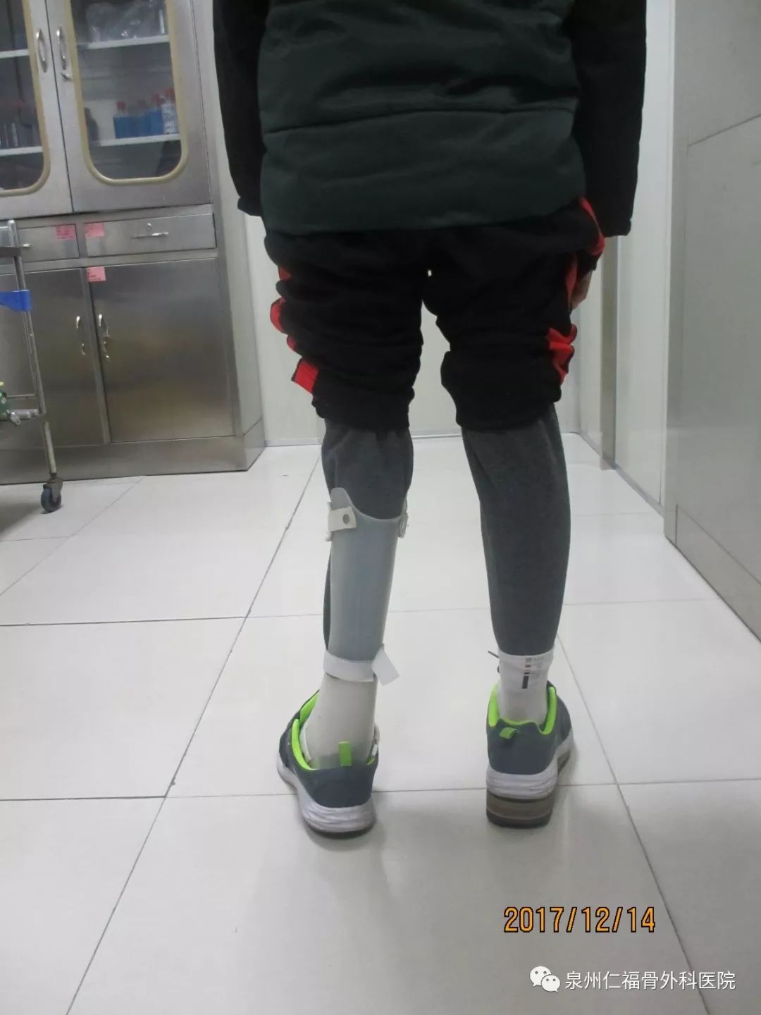 2016年,王教授曾为一位车祸造成的肢体后遗症患儿进行矫形手术.
