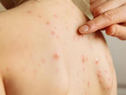 背后油腻瘙痒长痘几千只螨虫在你背后吃喝拉撒