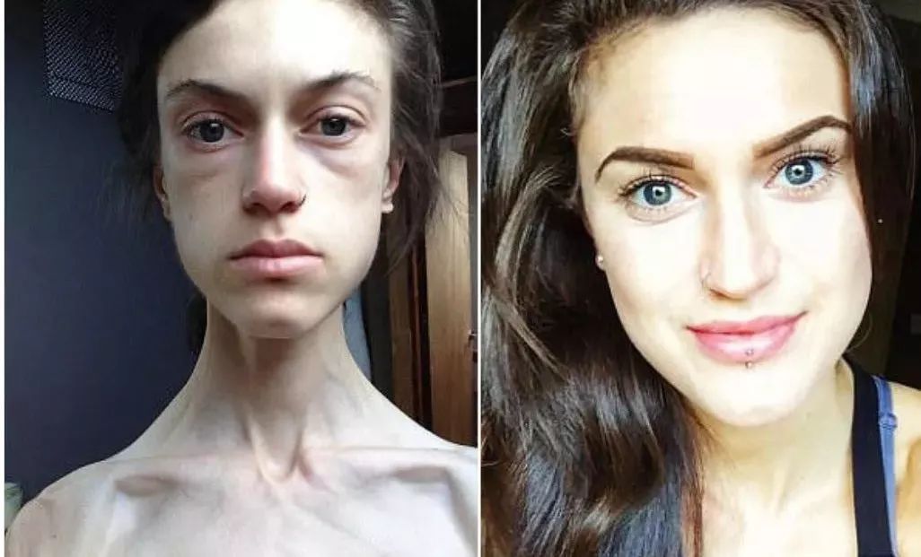 (节食减肥导致厌食症▽)有人尝试了节食半个月,只吃水果,不得不说体重