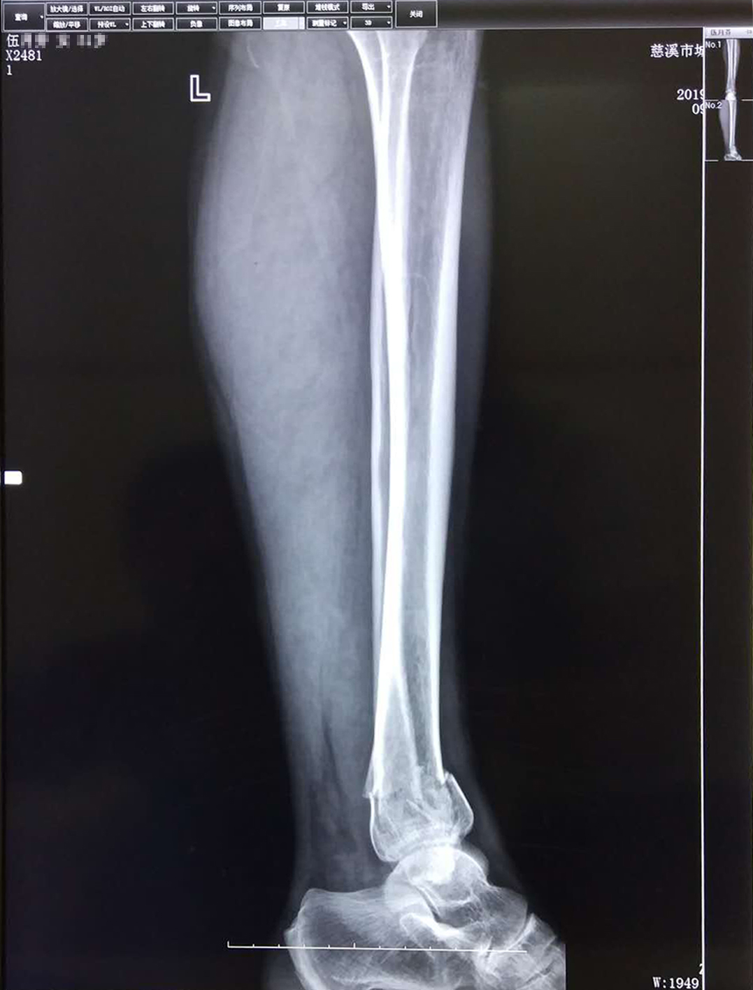 孙培权医师杏林妙手 成功使下腿双骨折错位患者康复_伍女士