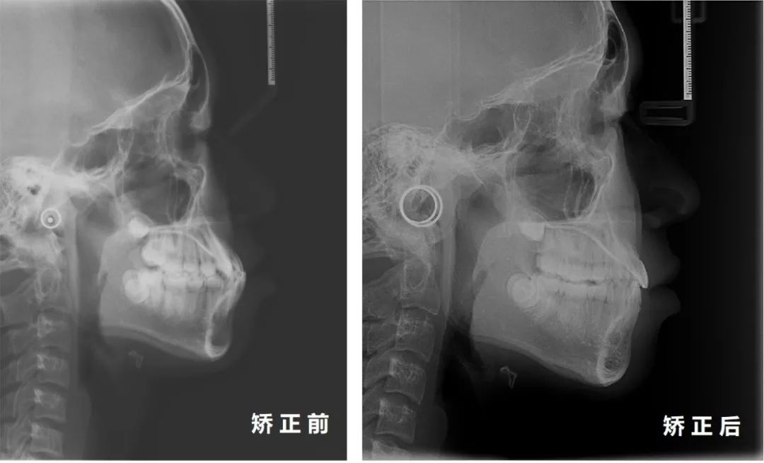 儿童头颅侧位片图片