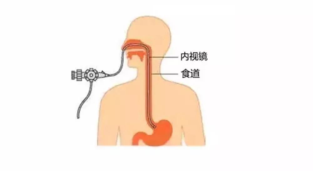 人到中年有无症状都要做一次胃镜网传的胃癌早期信号其实已经不早了