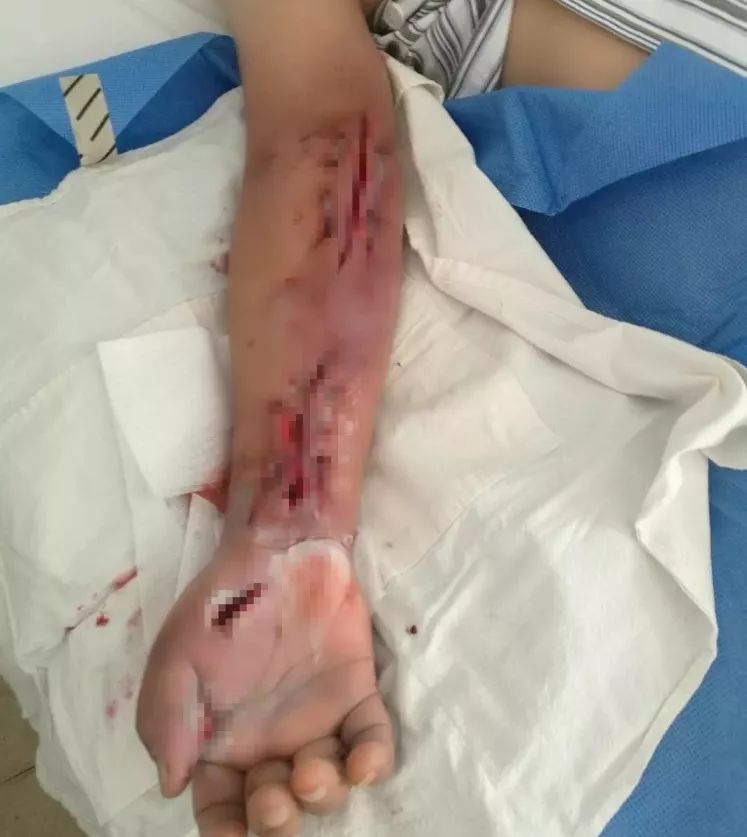 男子手臂烂得差点截肢居然跟做菜有关医生切开不忍直视