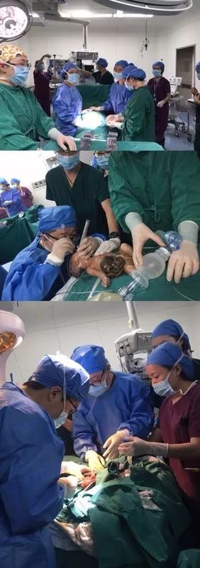 我院锦江院区产科和多学科合作首次产时完成腹裂胎儿肠管回纳及修补术