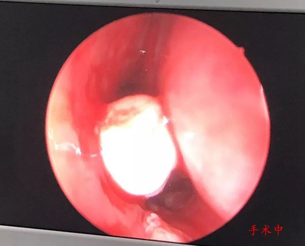 罕见七岁男童老流鼻涕竟是鼻腔里长了颗牙