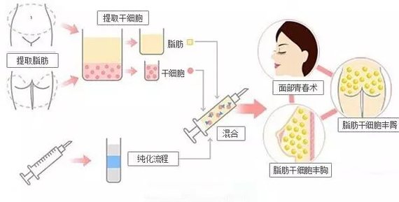 自体干细胞填充