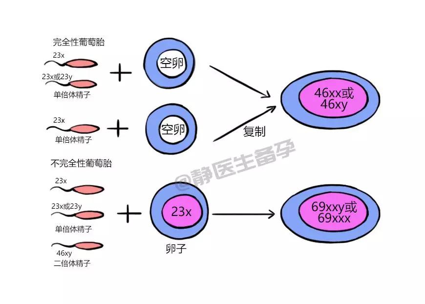 怪胎還是鬼胎葡萄胎瞭解一下