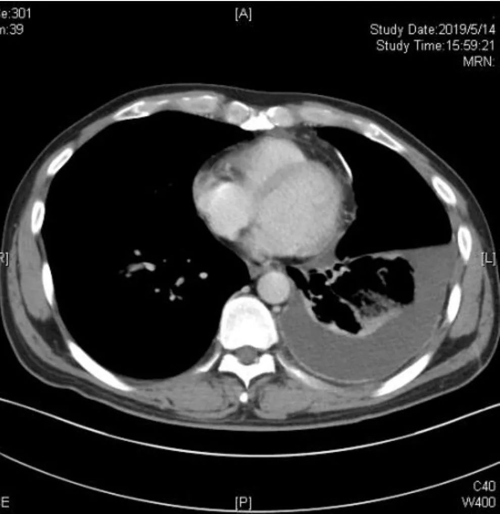 胸腔积液ct表现图片图片