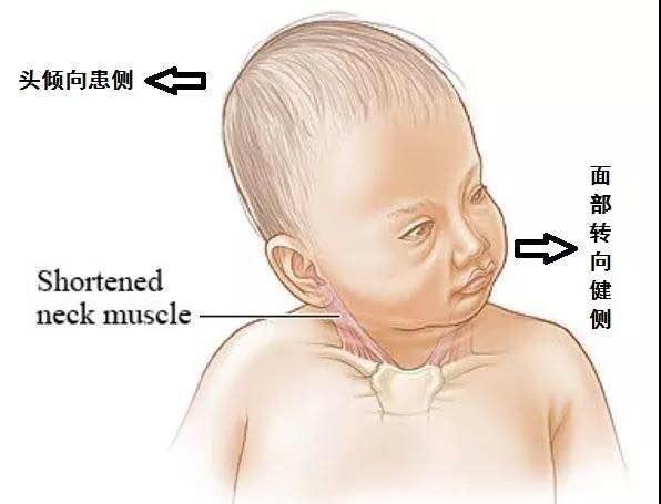 宝宝斜颈图片 五个月图片