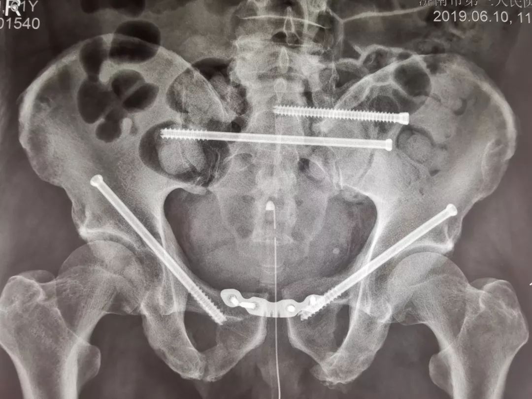 刘华水专栏骨盆粉碎性骨折经典手术案例分享
