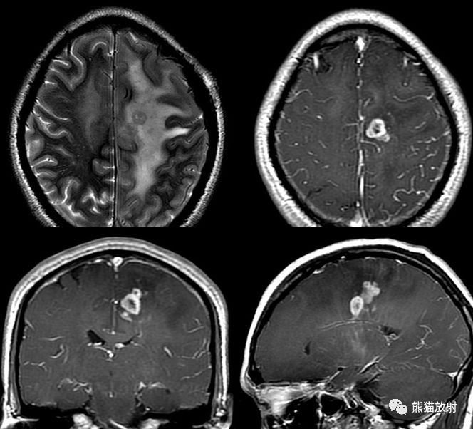 影像诊断病理丨星形细胞肿瘤