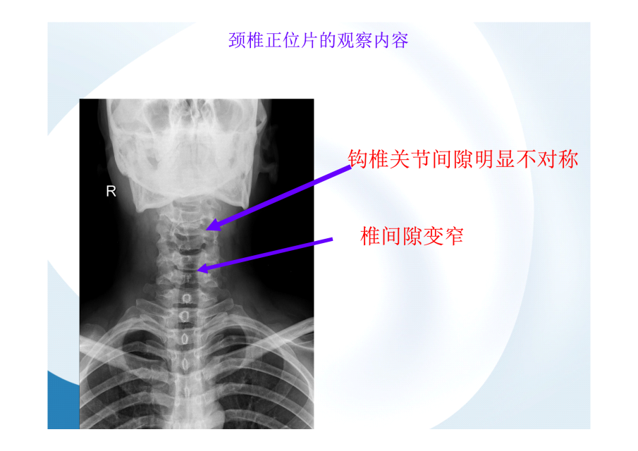 神级别的颈椎影像图谱