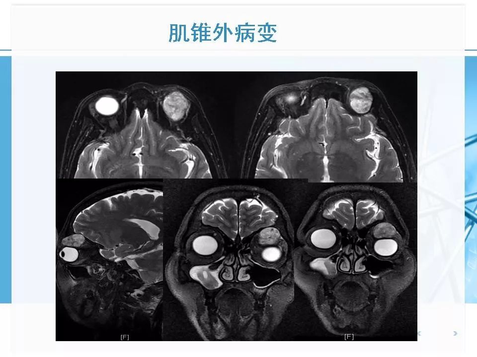 眼眶及眼球病变mr表现影像天地