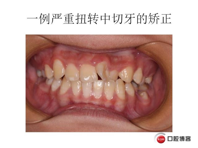 一例中切牙重度扭转的矫治过程