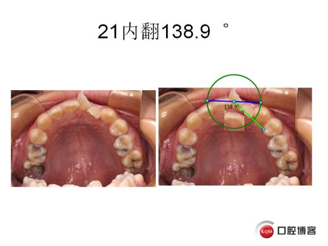 一例中切牙重度扭转的矫治过程