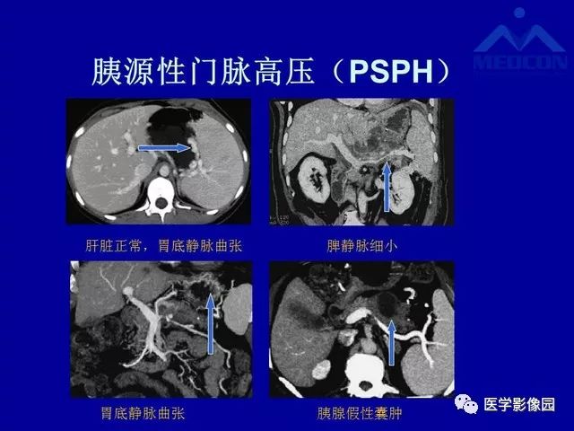 门静脉工字型图片