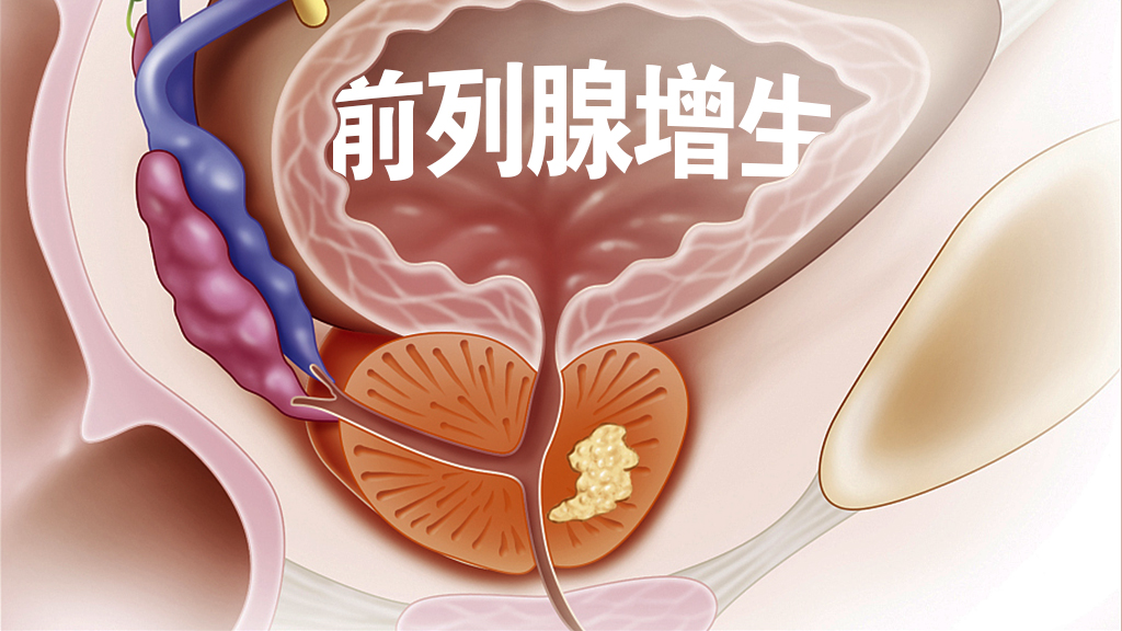 膀胱颈增生图片