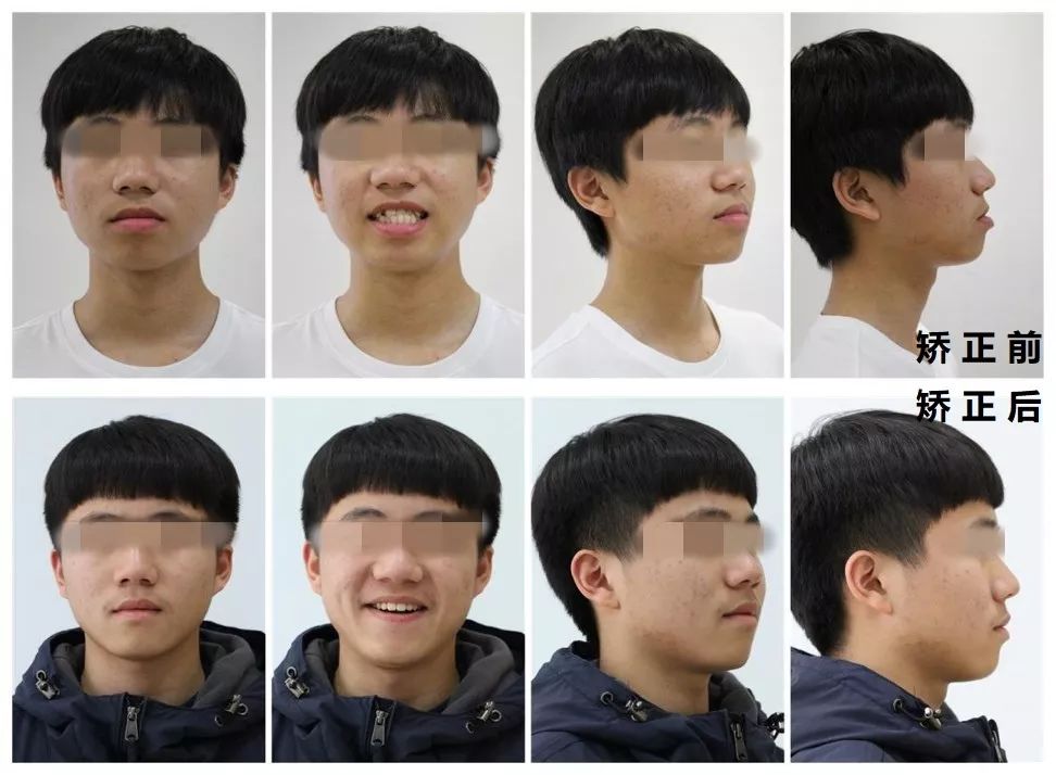 或者轻中度的骨性反颌,可以通过拔牙或者不拔牙矫正的方式改变牙齿的