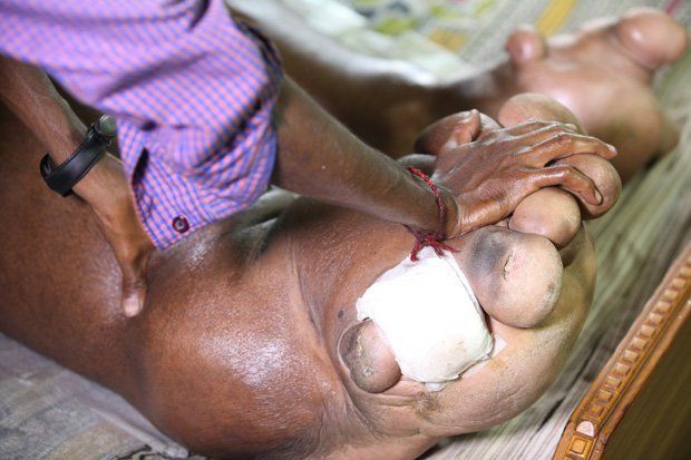 男子得了一种怪病右腿肿胀如象腿一条腿的重量将达到220斤