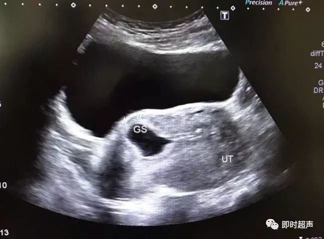 疤痕妊娠的超声图片图片