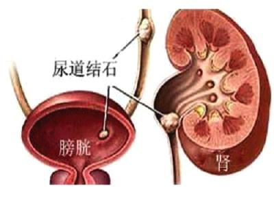 腎結石發作疼痛該怎麼辦吃什麼能緩解發作時的疼痛