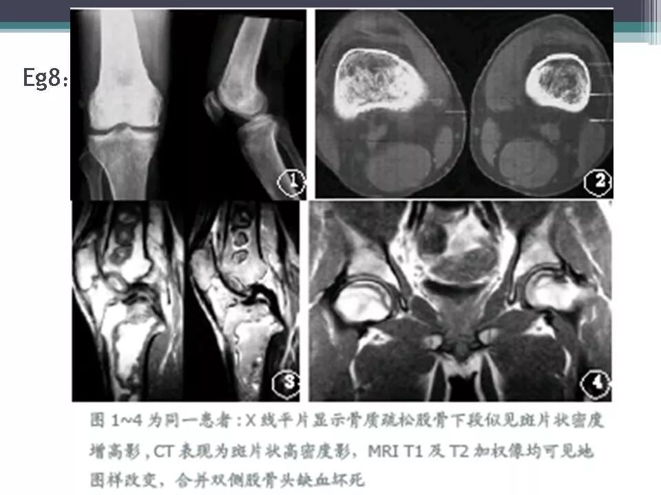 骨梗死的影像诊断影像天地