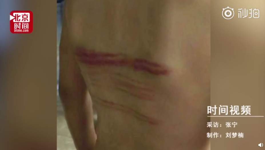 一年级女孩背部被班主任抽出血痕 家长询问遭反怼"你想怎样"