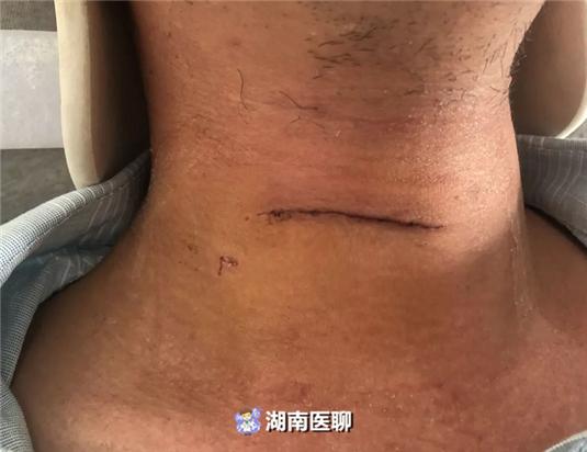 男子脖子酸痛加剧走路发飘最严重颈椎病可致瘫痪