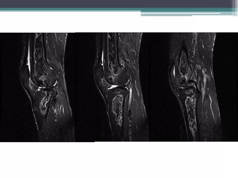 骨梗死的影像诊断影像天地
