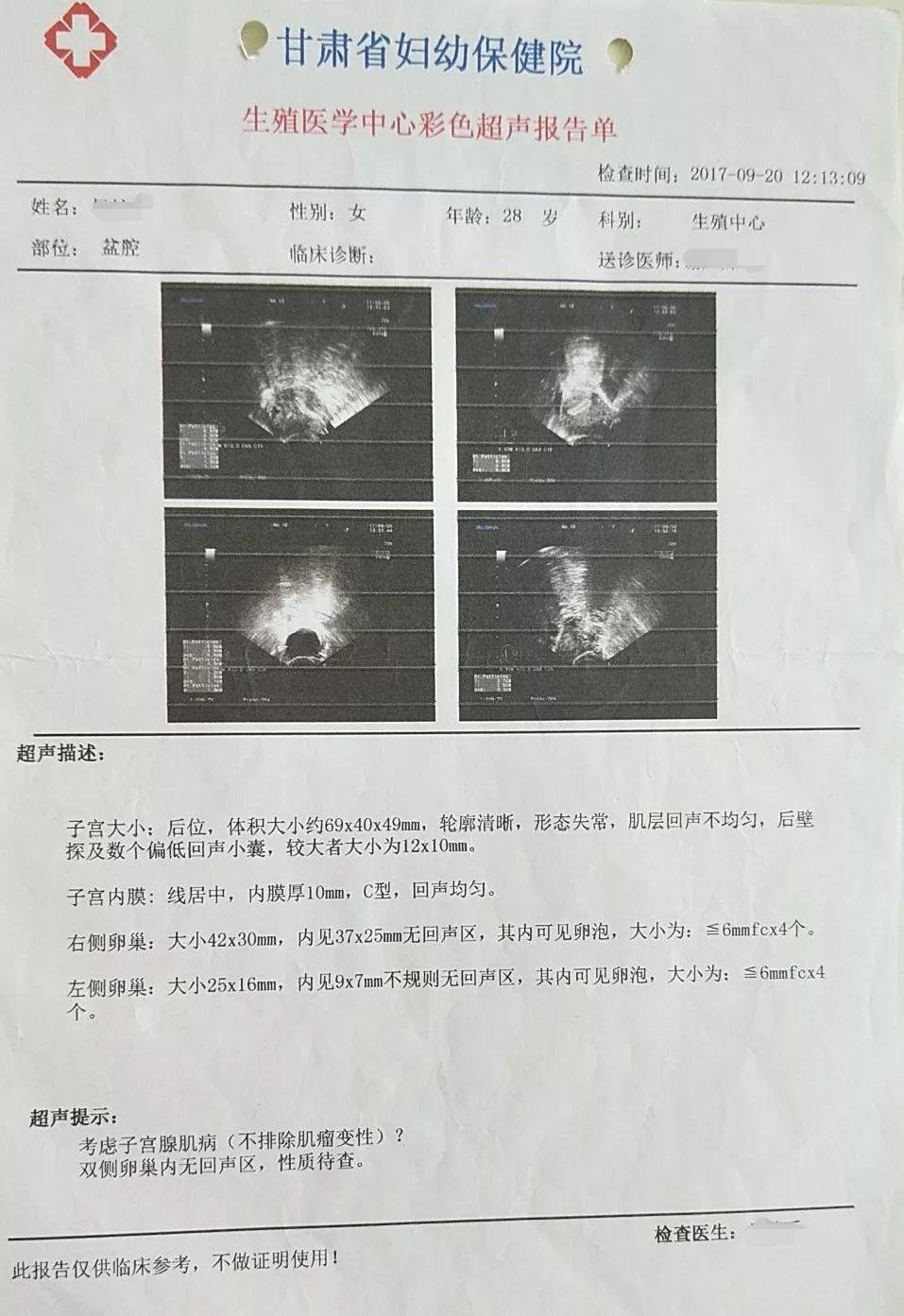 子宫肌瘤彩超单图片图片