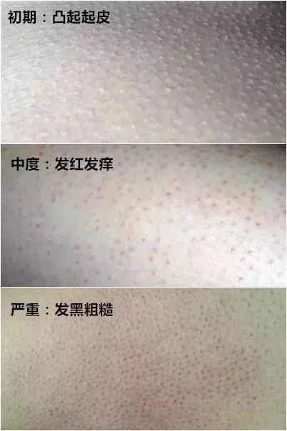 鸡皮肤用果酸还是杏仁酸(鸡皮肤用了果酸更严重是怎么回事)