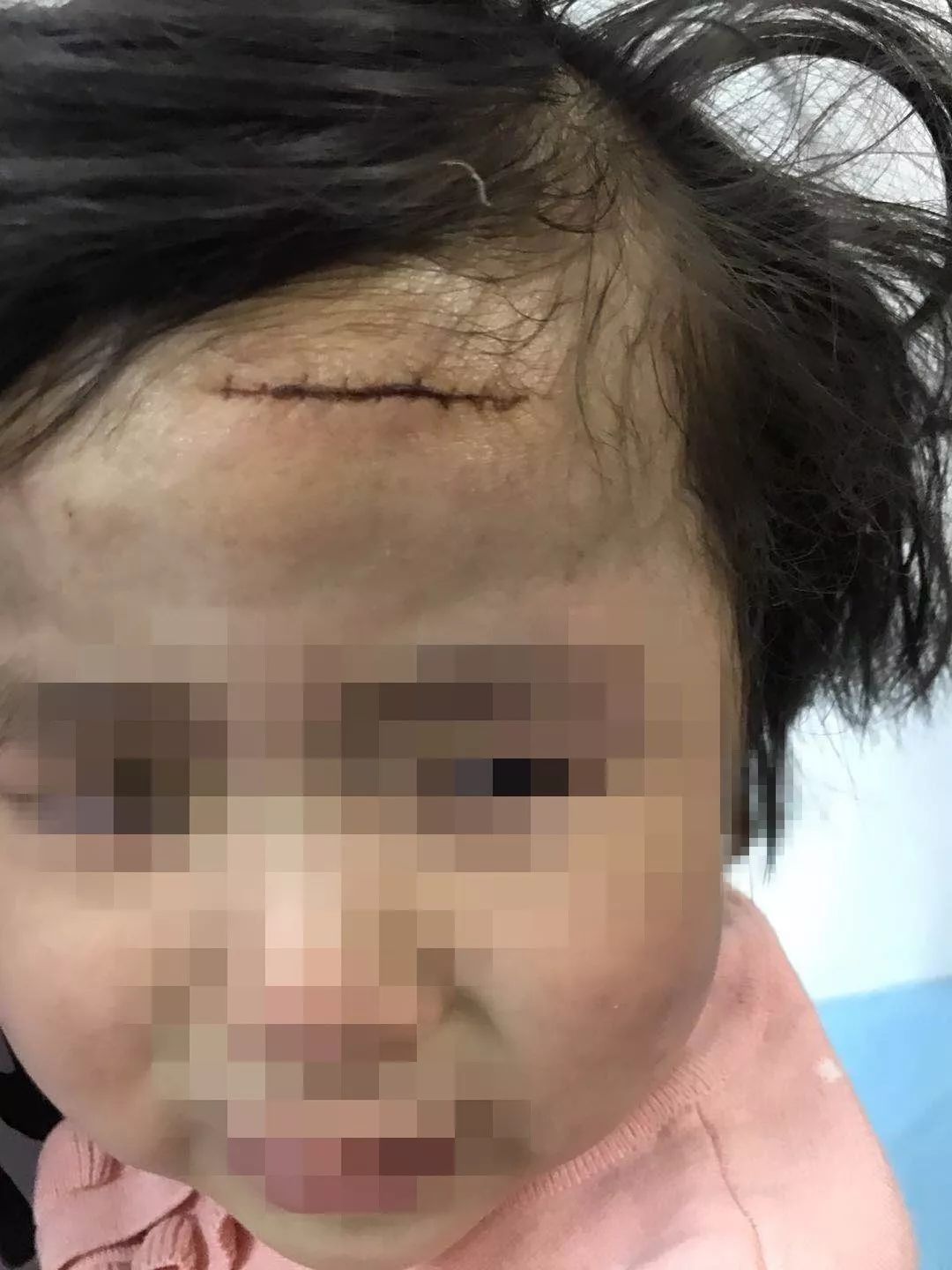 闯祸的台阶 3岁女童在培训机构被推倒,额头缝了15针