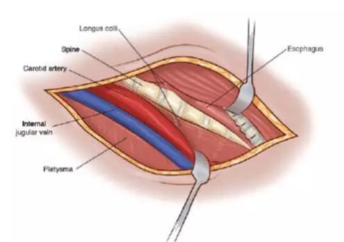 颈椎前路手术入路图解图片