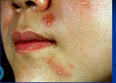 扁平疣寻常疣是常见病毒性皮肤病皮肤医生讲解病毒性皮肤病