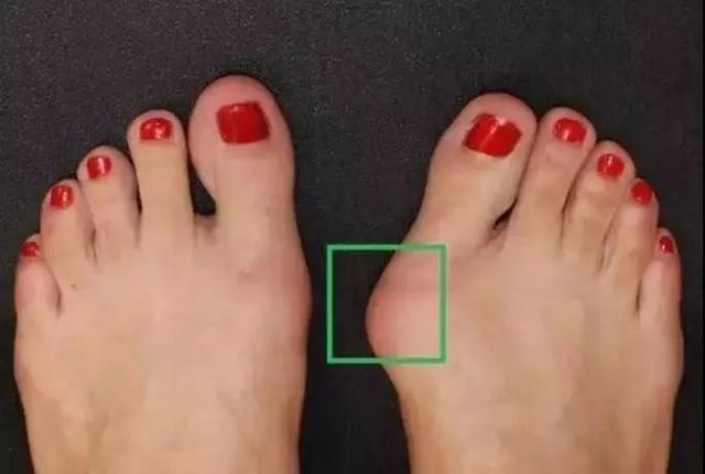 拇外翻是中老年女性的高发病只因年轻时不注意这件事