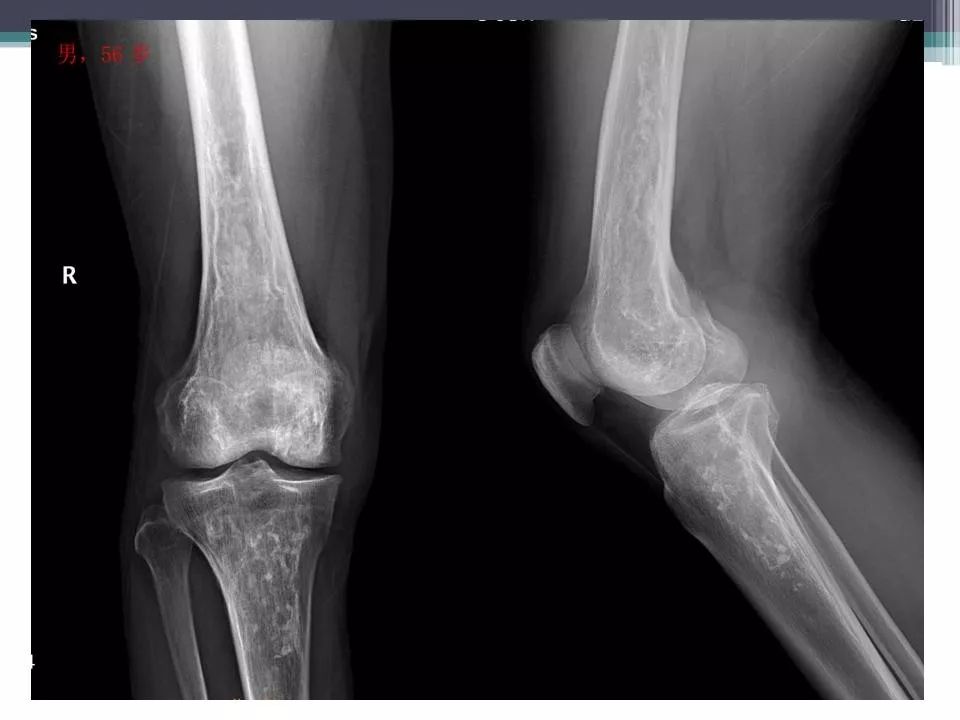 骨梗死的影像诊断影像天地