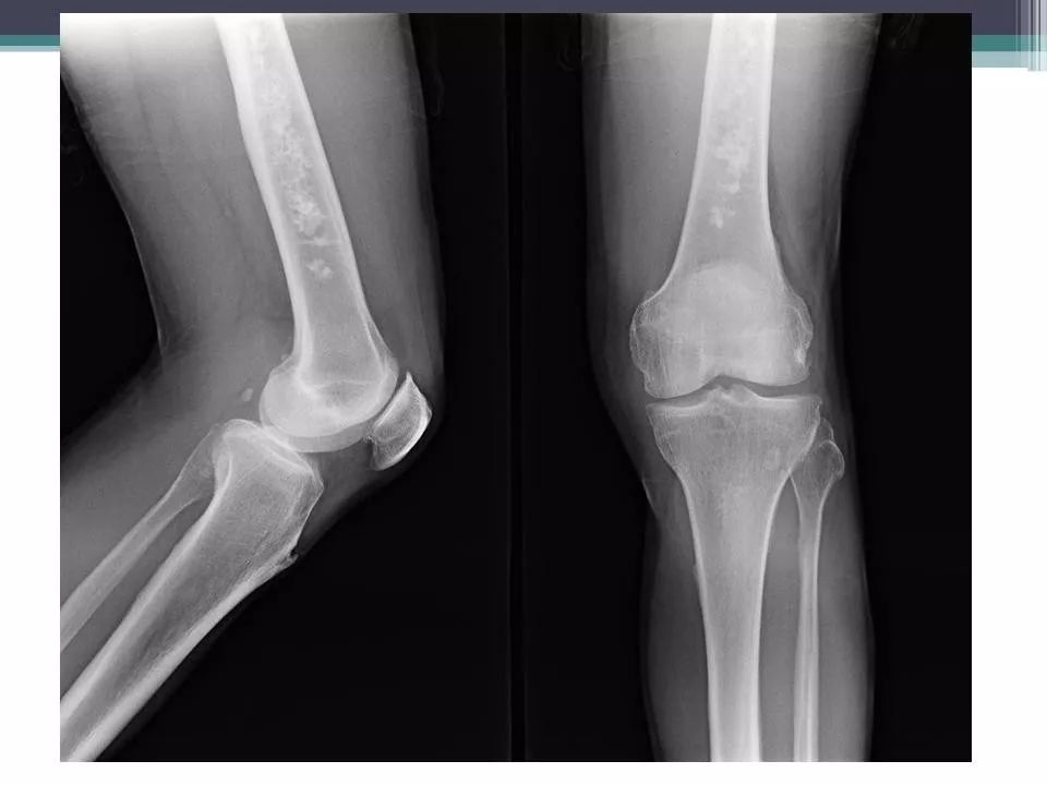 骨梗死的影像诊断影像天地