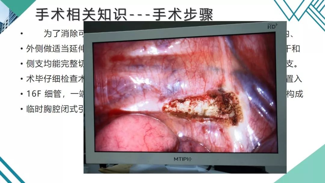 交感神经链切除术图片