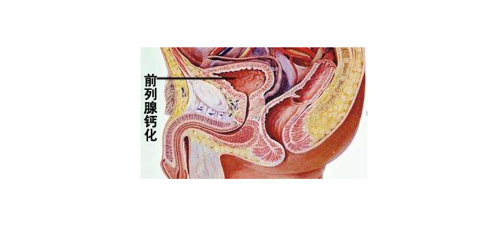 前列腺钙化图解图片