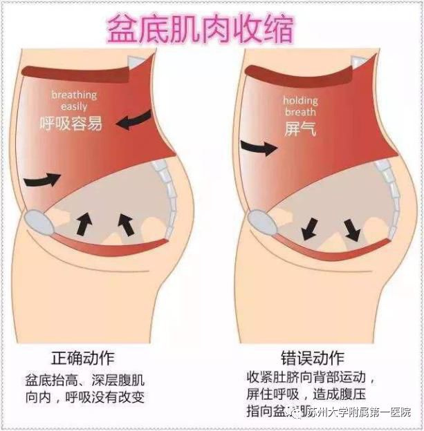 我們可通過盆底肌訓練逐漸實現盆底肌肉群的康復和強壯3盆底肌訓練即