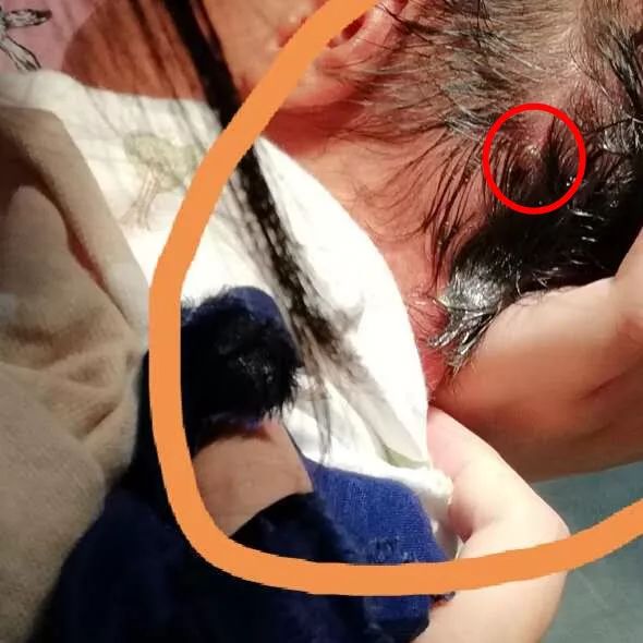 恐怖,夺命虫钻进小婴儿后脑勺