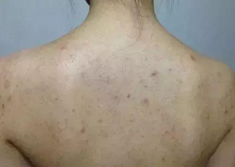 正是洗澡用的毛巾和搓澡巾很多人背部的小痘痘不断细菌含量会高达数